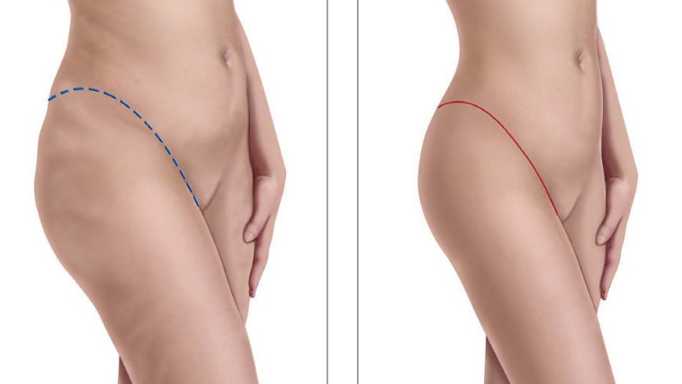 lifting cuisses Turquie