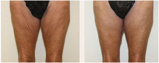 lifting cuisses Turquie