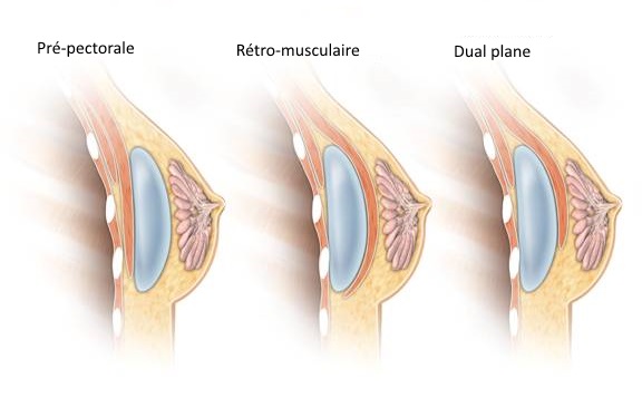 Augmentation mammaire Turquie : Prix pose implant mammaire