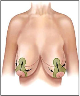 reduction mammaire Turquie