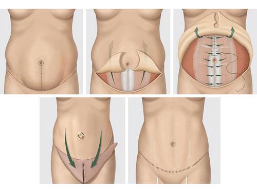 abdominoplastie Turquie