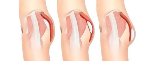 implant fessier Turquie prix