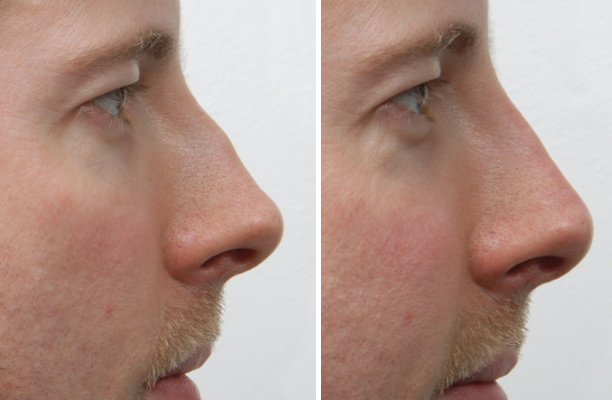 rhinoplastie medicale tunisie