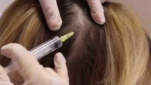 mesotherapie cheveux tunisie