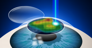 lasik Turquie