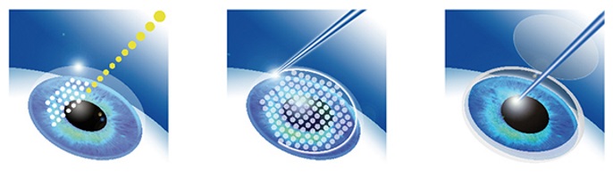 lasik femtoseconde tunisie