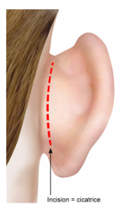 chirurgie oreilles decollees