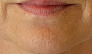 menton peau orange