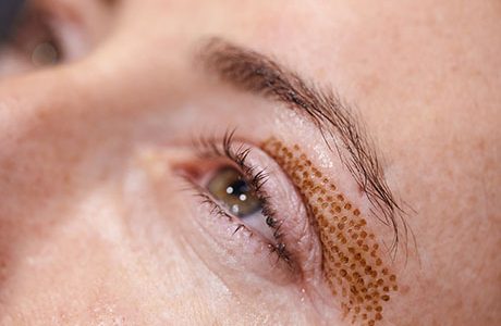 Blépharoplastie sans chirurgie : Indications et causes du relâchement des paupières