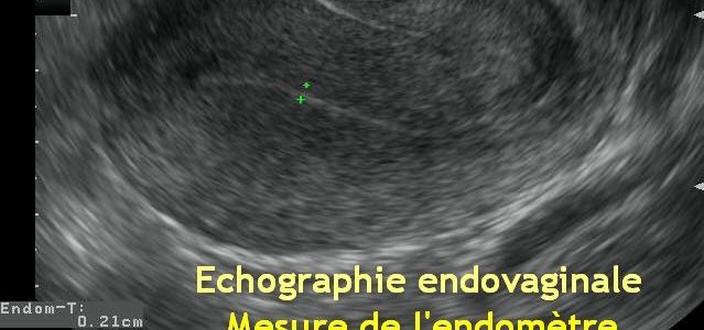 Qu’est-ce que l’échographie endovaginale ?