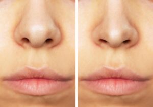 Rhinoplastie bout nez turquie