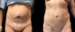 Abdominoplastie circulaire Turquie