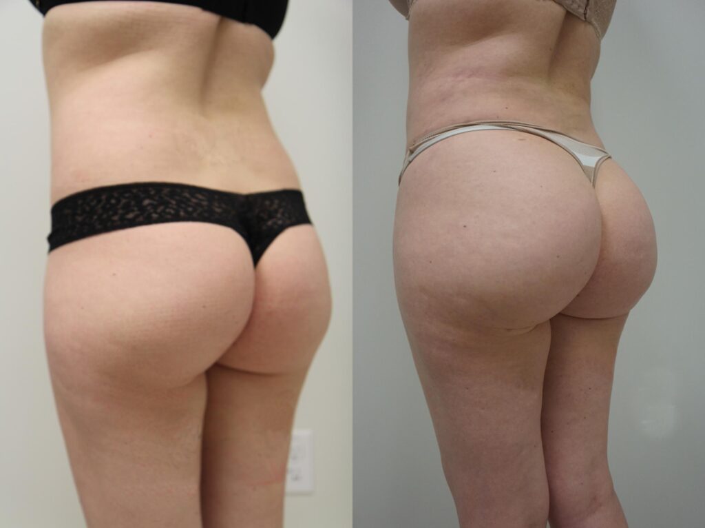 augmentation fesses Turquie