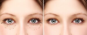 canthoplastie Turquie
