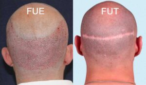 Fue follicular Unit transplant