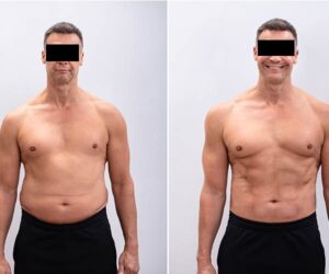 abdominoplastie circonferentielle