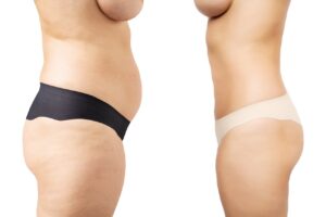 prix abdominoplastie circulaire