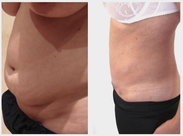 Photos avant et après abdominoplastie complète Turquie