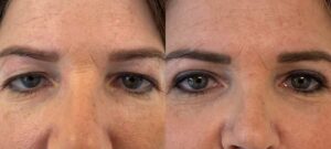 chirurgie paupières supérieures