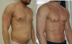 lipo six pack Turquie