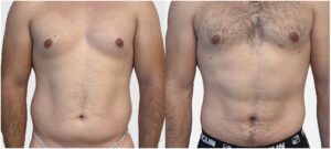 Lipo abdominale Turquie