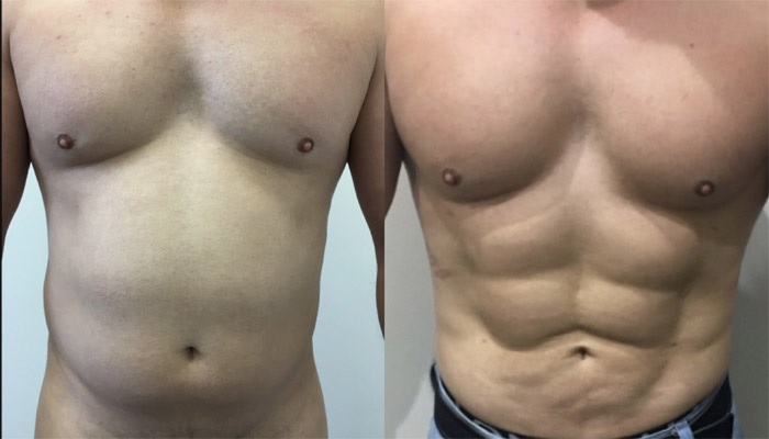 liposuccion abdominale Turquie