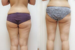 Liposuccion fesses Turquie prix