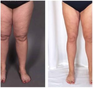 lipo jambes Turquie