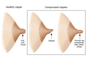 Mamelons compresses