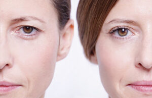 paupières supérieures Turquie