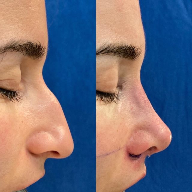 rhinoplastie Turquie 