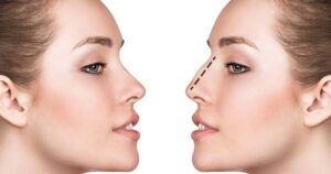 rhinoplastie ultrasonique Turquie