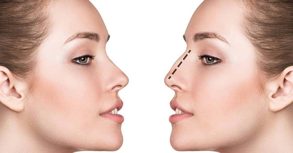 rhinoplastie ultrasonique Turquie