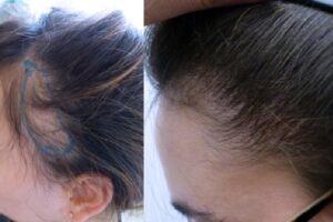 Greffe cheveux femmes Turquie
