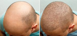 greffe cheveux homme