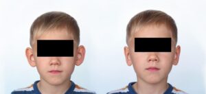 Oreilles décollées enfant