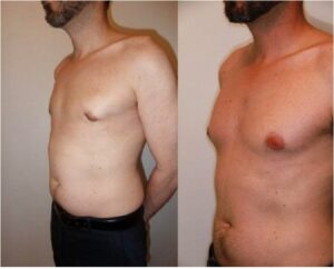 réduction seins homme