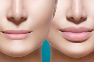 lip lift Turquie
